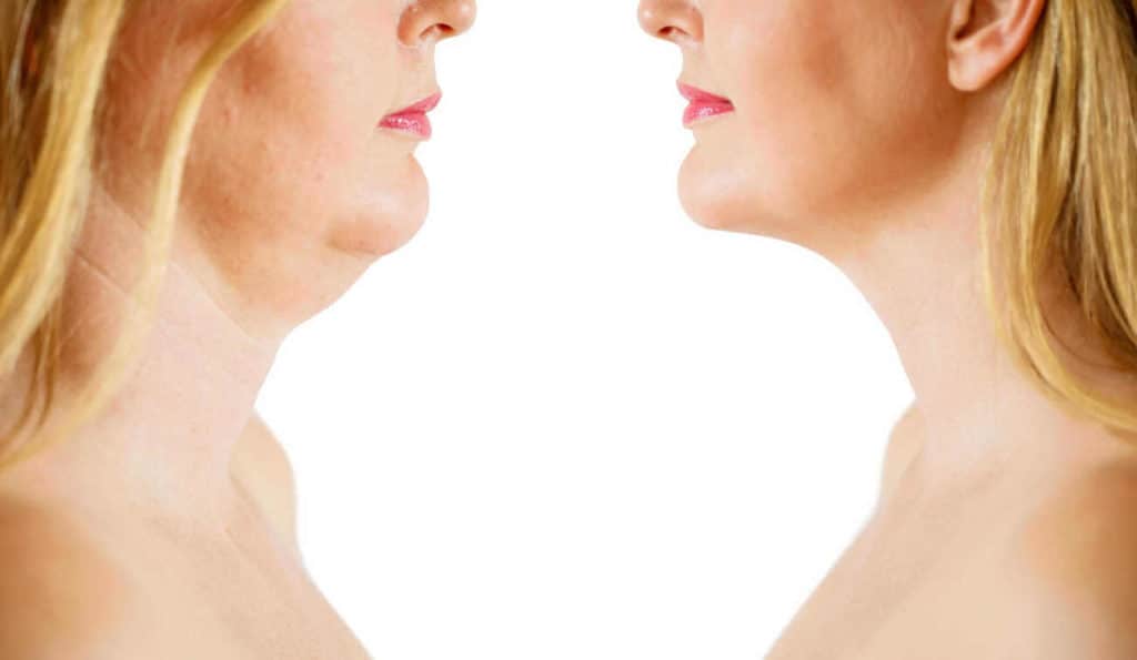 Double Chin treatment Wednesbury before and after results