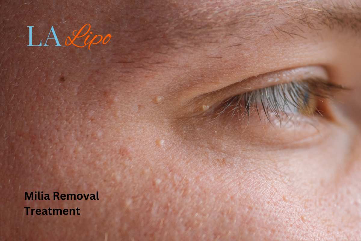 Cryopen Milia Removal: Is It the Easiest and Safest Option Wednesbury?