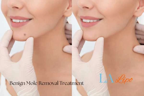 Before-and-after results following benign mole-removal treatment Wednesbury