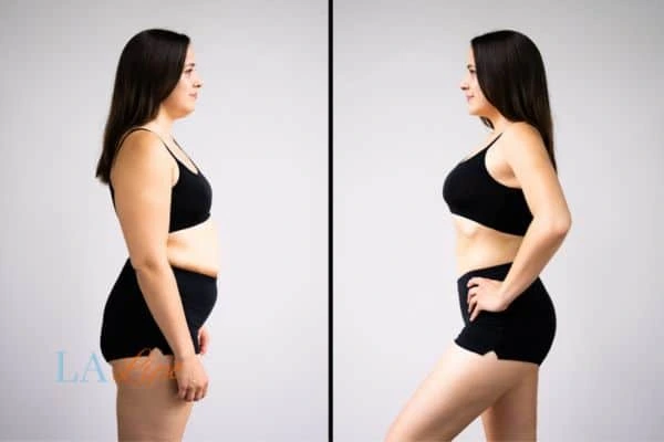 image of woman before and after results of LA-EMS Body Sculpting Wednesbury to help treat Diastasis recti