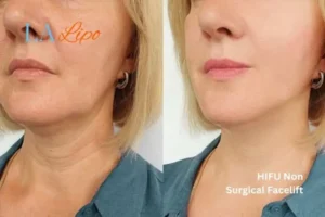 hi-fu for wrinkles Wednesbury before and after results