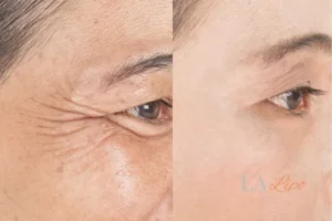 Before and after results of woman - HI-fu wrinkles reduction treatment Wednesbury