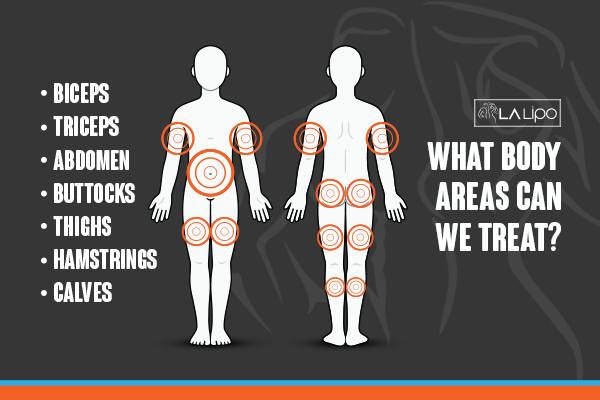 Graphic to show areas you can have LA-EMS Body Sculpting Wednesbury treatment.