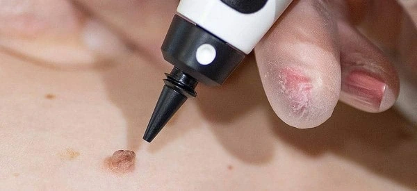 skin tag removal using cryopen Wednesbury