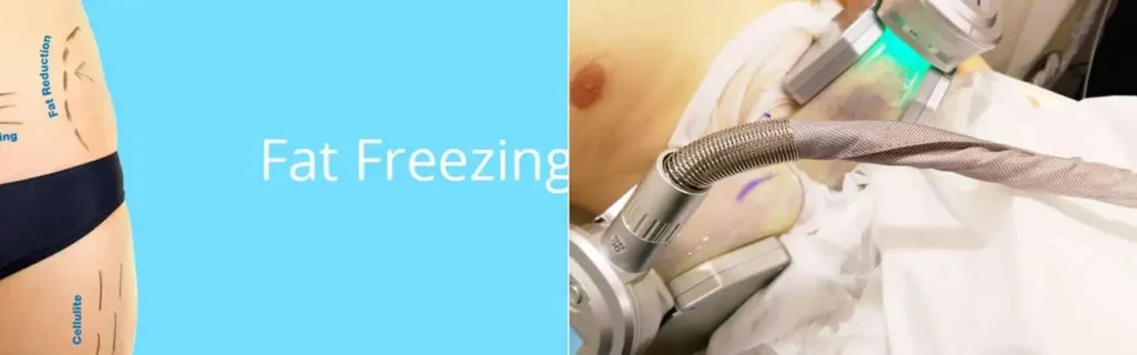 Fat freezing Wednesbury on multiple areas of the body
