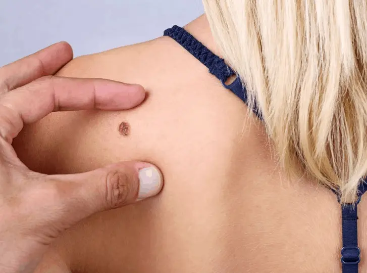 woman having mole removal Wednesbury consultation before treatment.