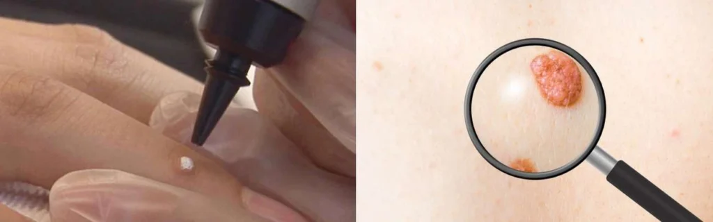 CryoPen practitioner Wednesbury assessing a benign mole before treatment
