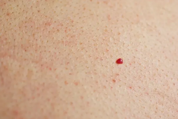close up of a cherry angioma Wednesbury