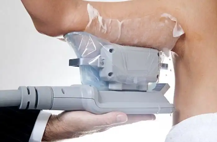 Picture of fat freezing Wednesbury on the upper arms.