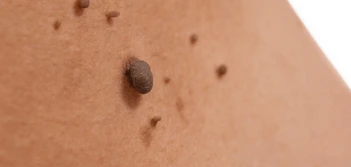 image of a skin tag Wednesbury