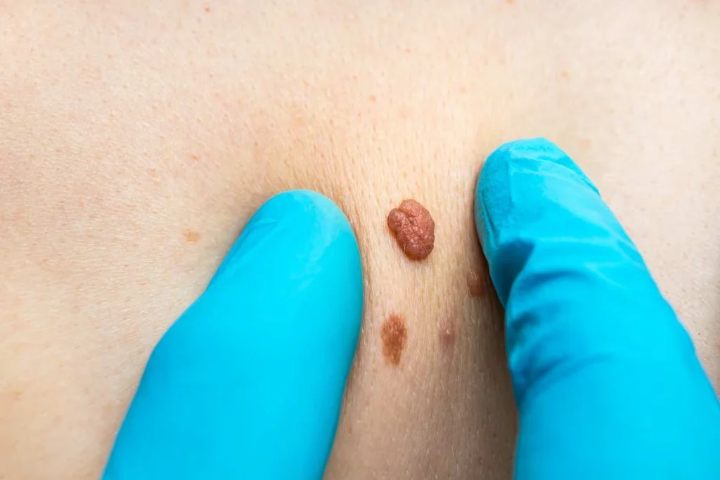 Consultant examining a skin tag Wednesbury