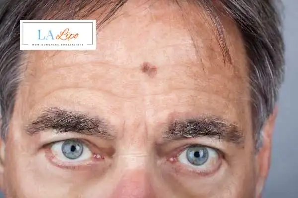 Solar Lentigo Removal Wednesbury image of man with mark on his forehead