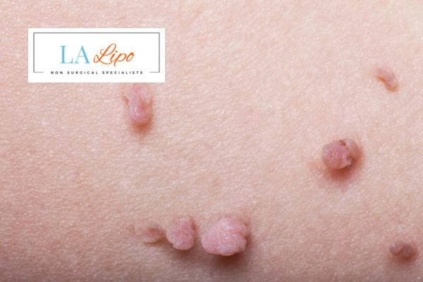 Does cryopen skin tag removal Wednesbury hurt? Find out now call our team today!