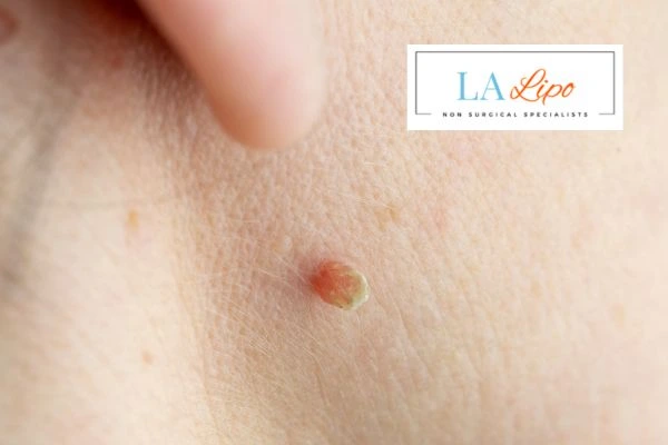 Book skin tag removal Wednesbury today speak to our team now!