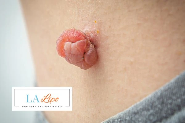 Interested in skin tag removal Wednesbury? Concerned about the pain? Find out more today!