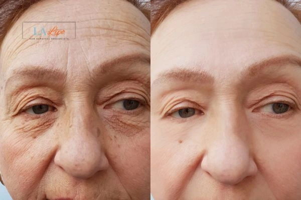 The powerful benefits of Morpheus8 Treatment Wednesbury - Call Our team today!