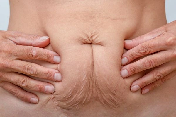 Image of a woman's stomach with loose skin - example of skin tightening Wednesbury options