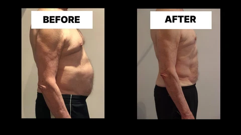 What Symptoms Can Diastasis Recti Cause in Men? Weak Core, Back Pain and Poor Posture Wednesbury